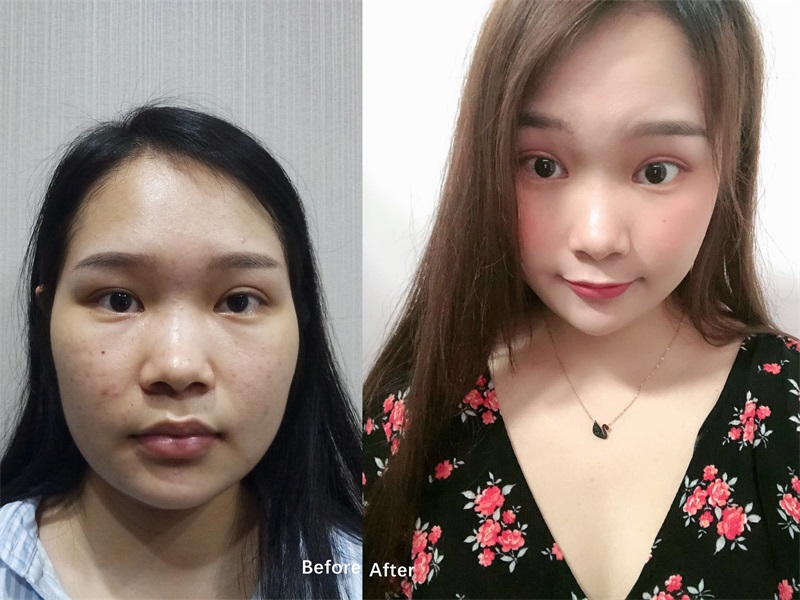 面部吸脂.jpg