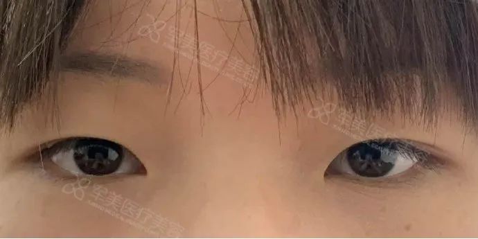 开眼角多少钱
