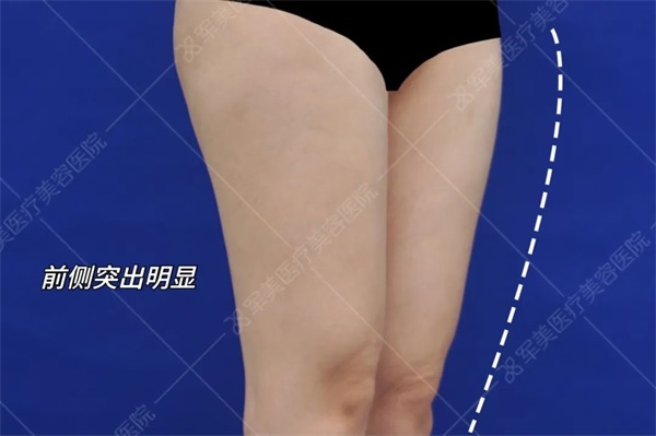 大腿吸脂大约多少钱