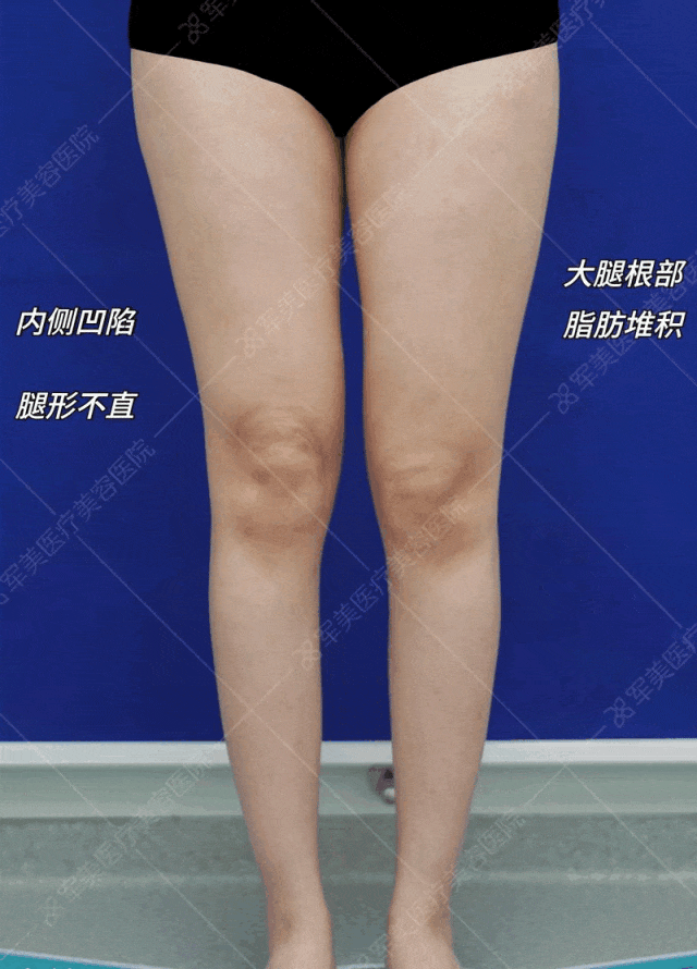 抽脂一般要价格表