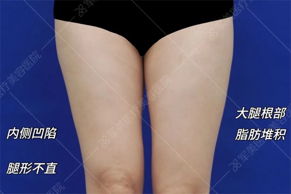大腿抽脂价位