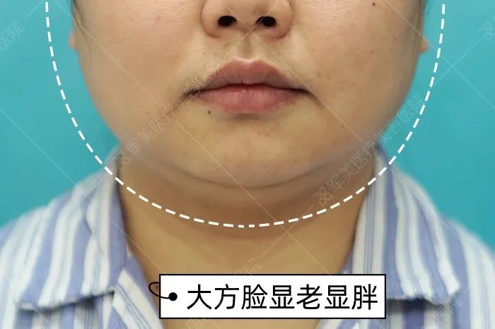面部v脸提升