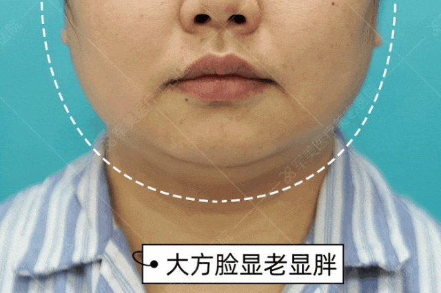 双下巴吸脂多少钱