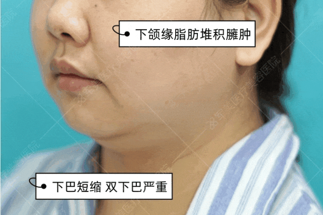 下颌线吸脂