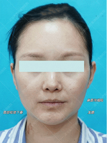 面部抗衰提升做什么项目