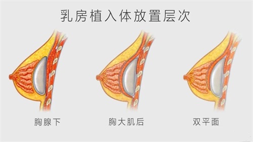 假体隆胸手感好吗