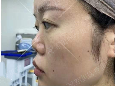 挛缩鼻修复前后
