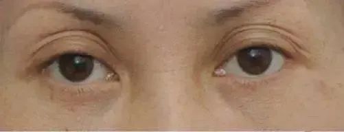 多层眼皮怎么恢复成双眼皮