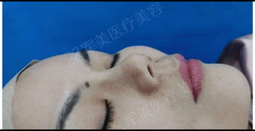 鼻综合效果怎么样