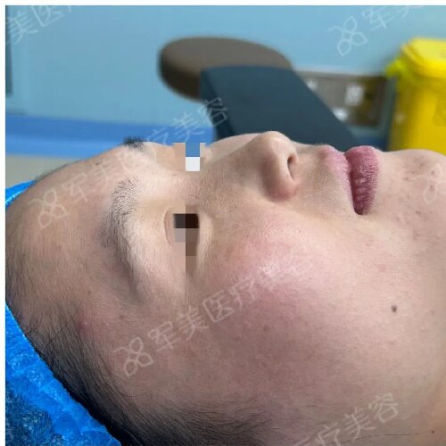 鼻综合用什么材料最好