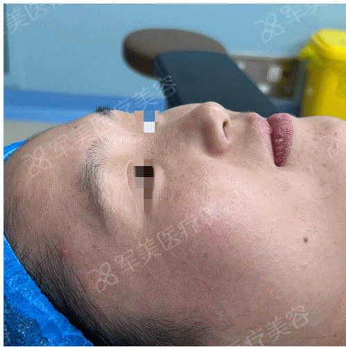 鼻综合一般价格多少钱
