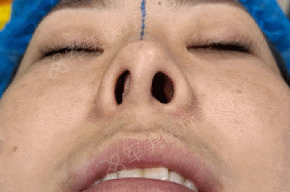 鼻综合包括哪些项目