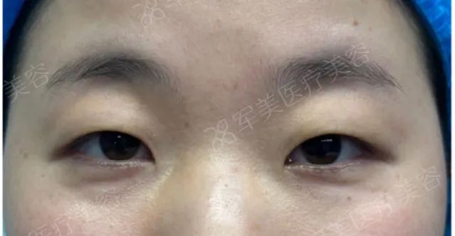 割双眼皮后1-7天恢复图