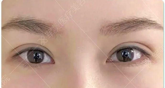 单眼皮怎么自然变成双眼皮呢