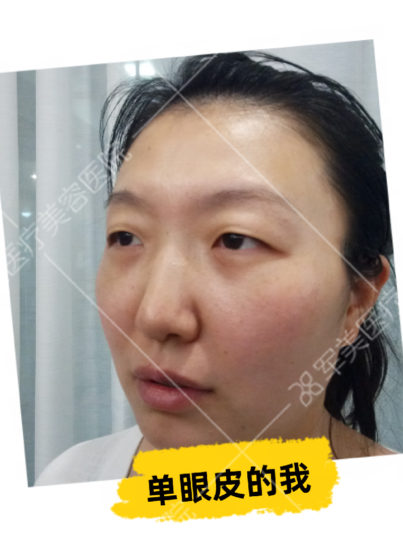 做双眼皮哪家医院好