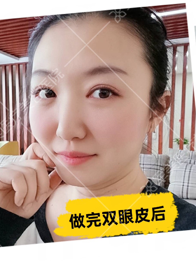 做双眼皮哪家医院好
