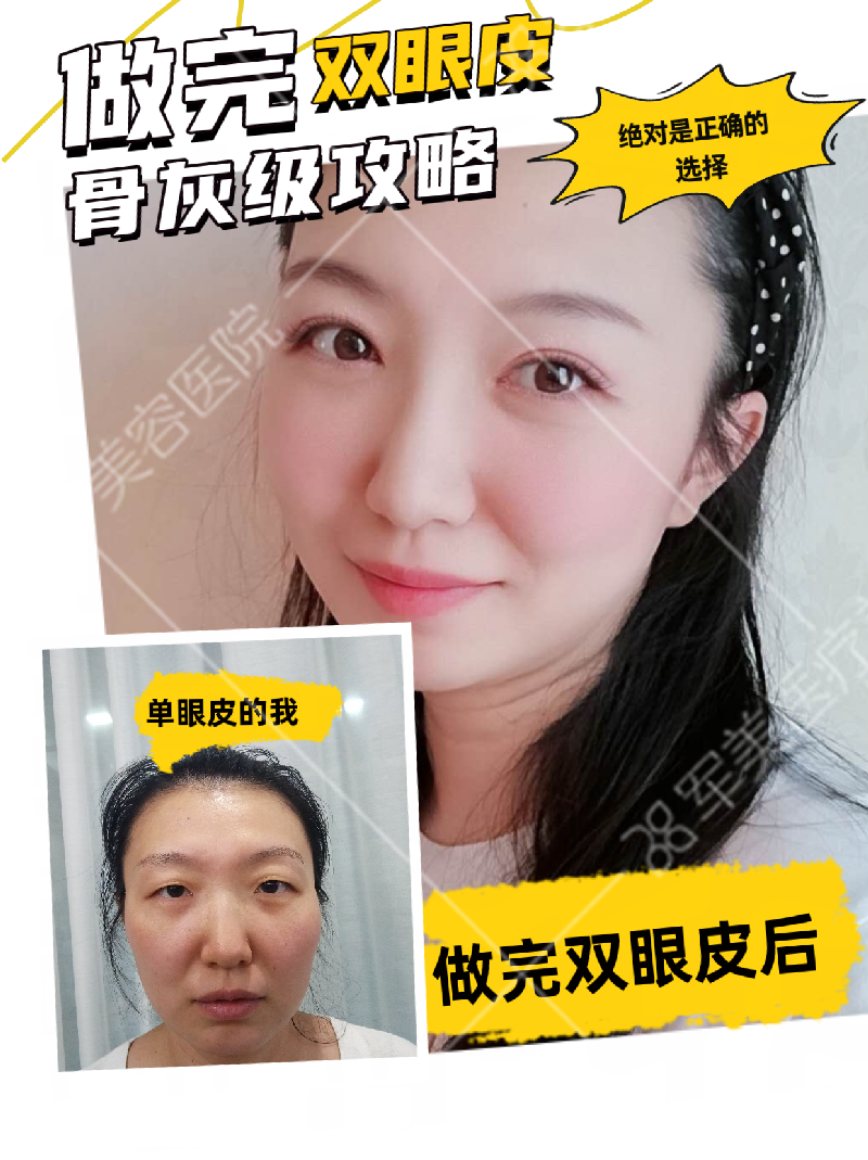 做双眼皮要多少钱