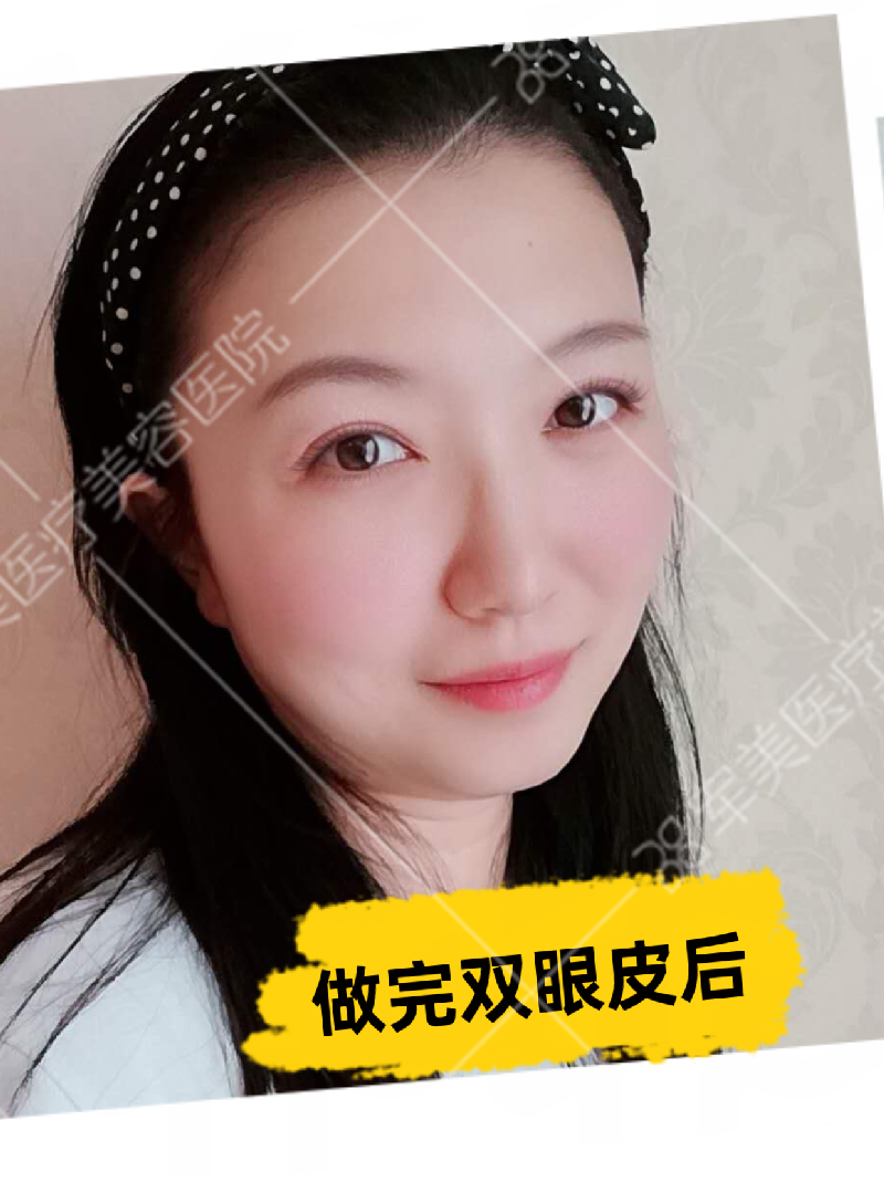 做双眼皮要多少钱