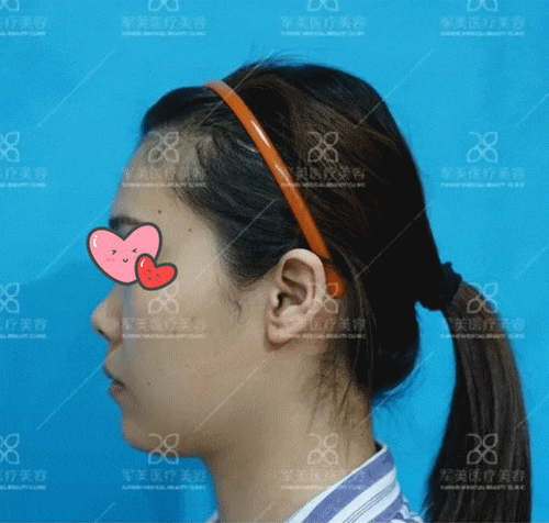 鼻孔大怎么改善