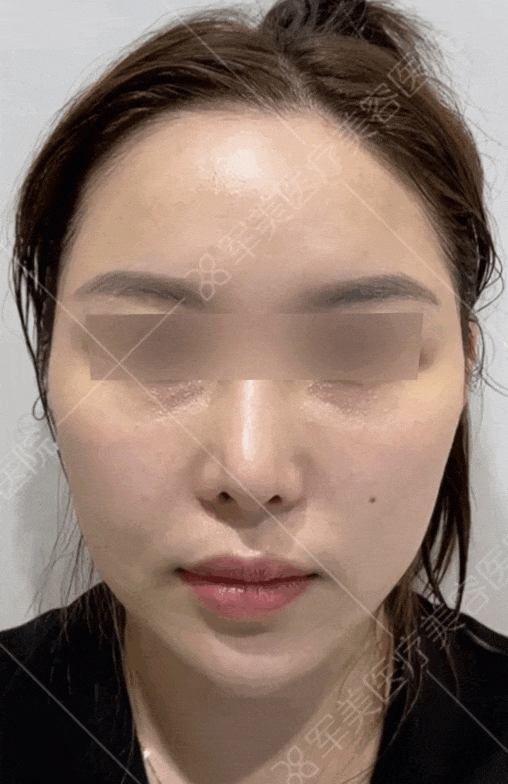 馒化脸怎么解决