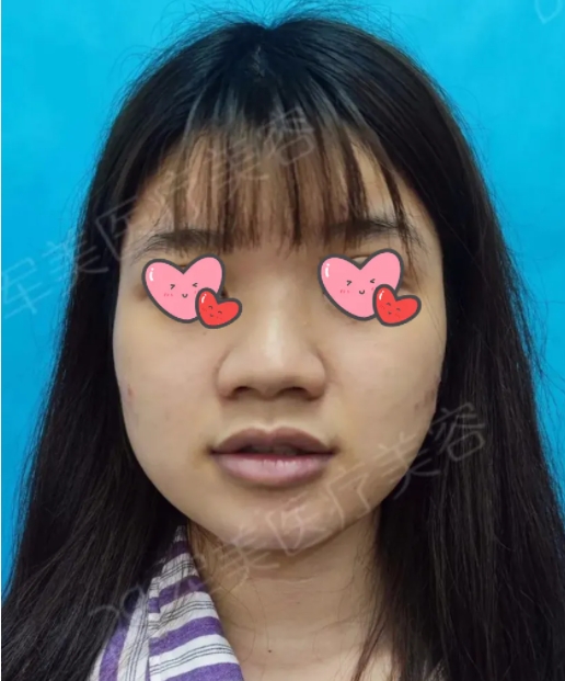 鼻头短怎么改善