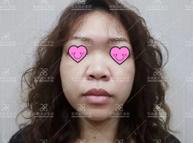 广州军美隆鼻怎么样