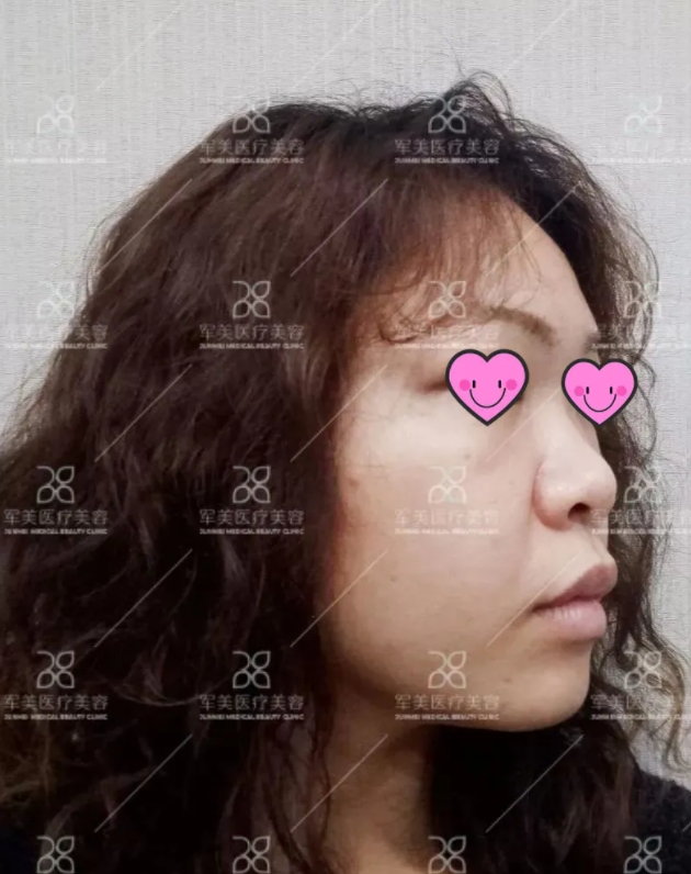 广州军美隆鼻案例