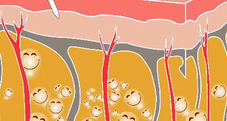 腰腹吸脂后多久消肿