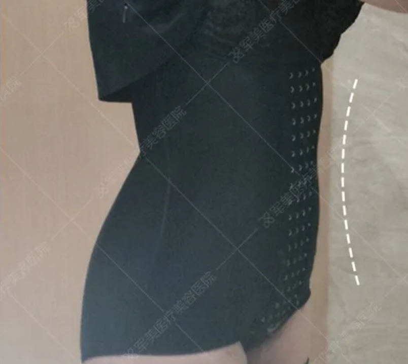 腰腹环吸多久能看到效果
