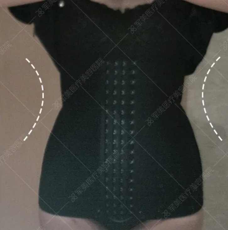 腰腹环吸多久恢复