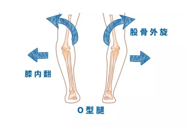 腿型不好看怎么改变