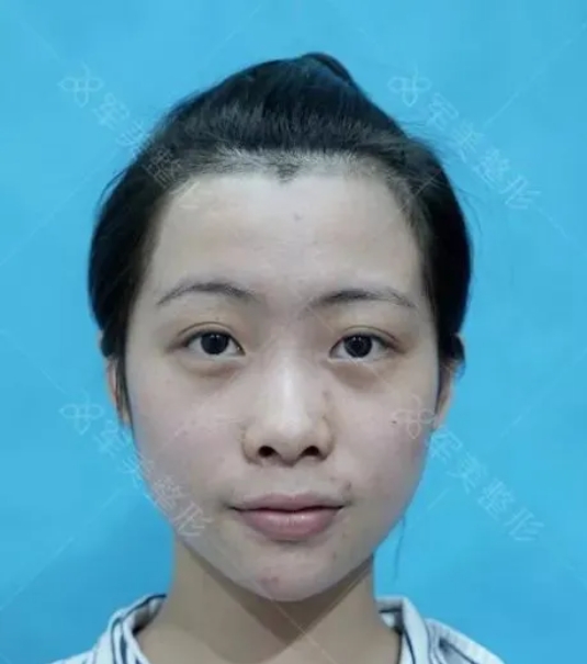 耳软骨鼻综合