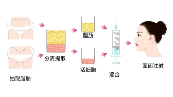 脂肪填充面部哪家医院好