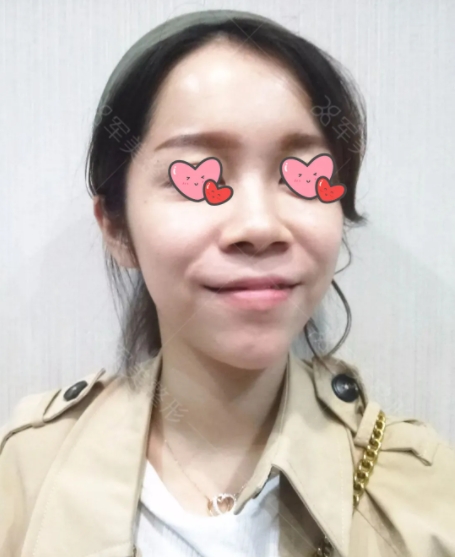 郑少雄隆鼻案例
