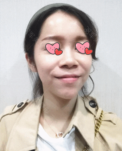 缩窄鼻翼案例