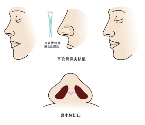 耳软骨鼻综合