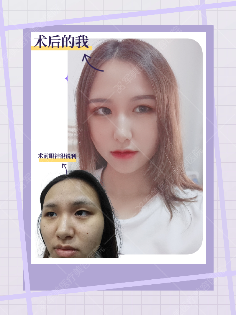 广州郑少雄医生做眼睛案例