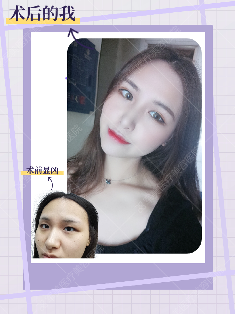 广州郑少雄医生做眼睛案例