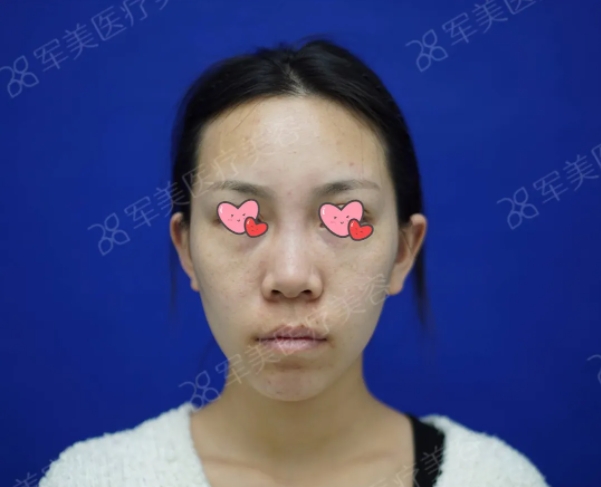 半肋鼻综合案例