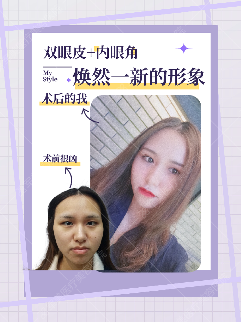 单眼皮变双眼皮案例