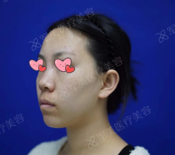 半肋鼻综合案例