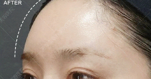 瘦脸针适合什么样的人打