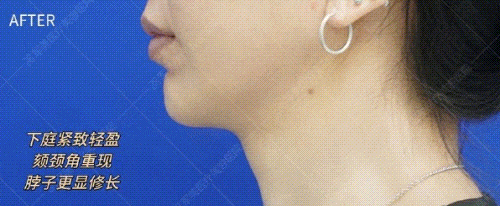 瘦脸针适合什么样的人打