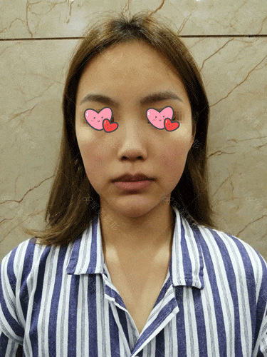 塌鼻子怎么拯救