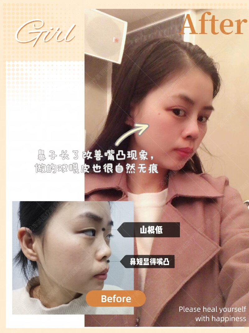 郑少雄隆鼻案例