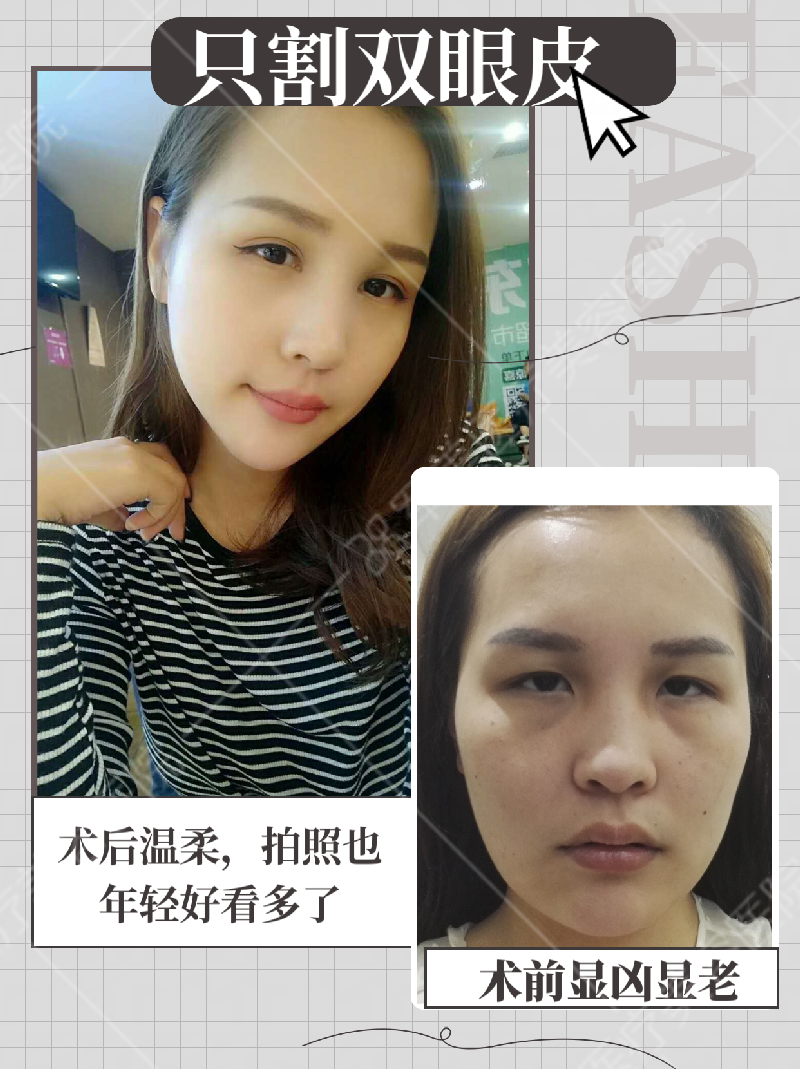 郑少雄割双眼皮案例