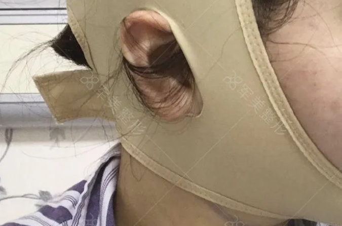 面部吸脂头套要戴多久
