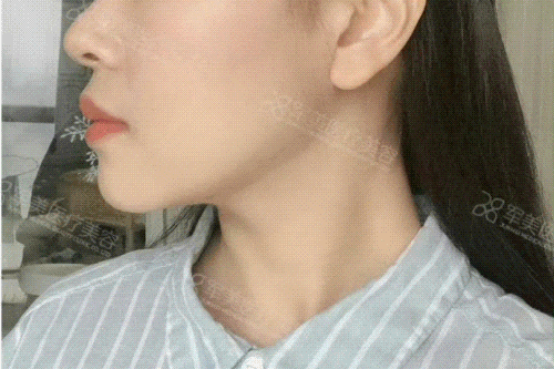 面部吸脂术后头套怎么戴正确
