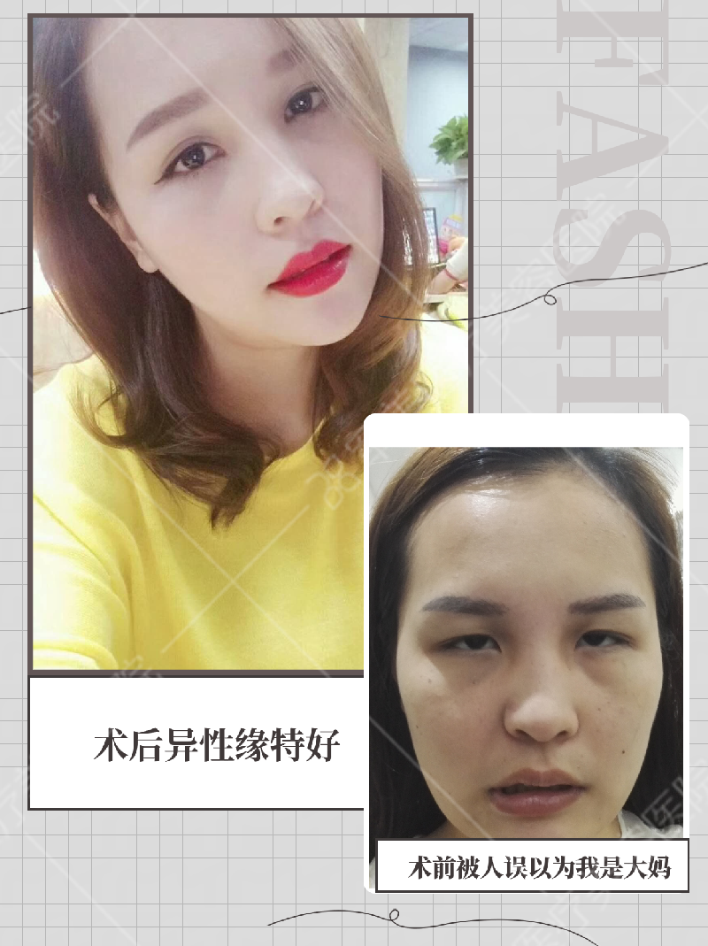 广州割双眼皮口碑好的医生