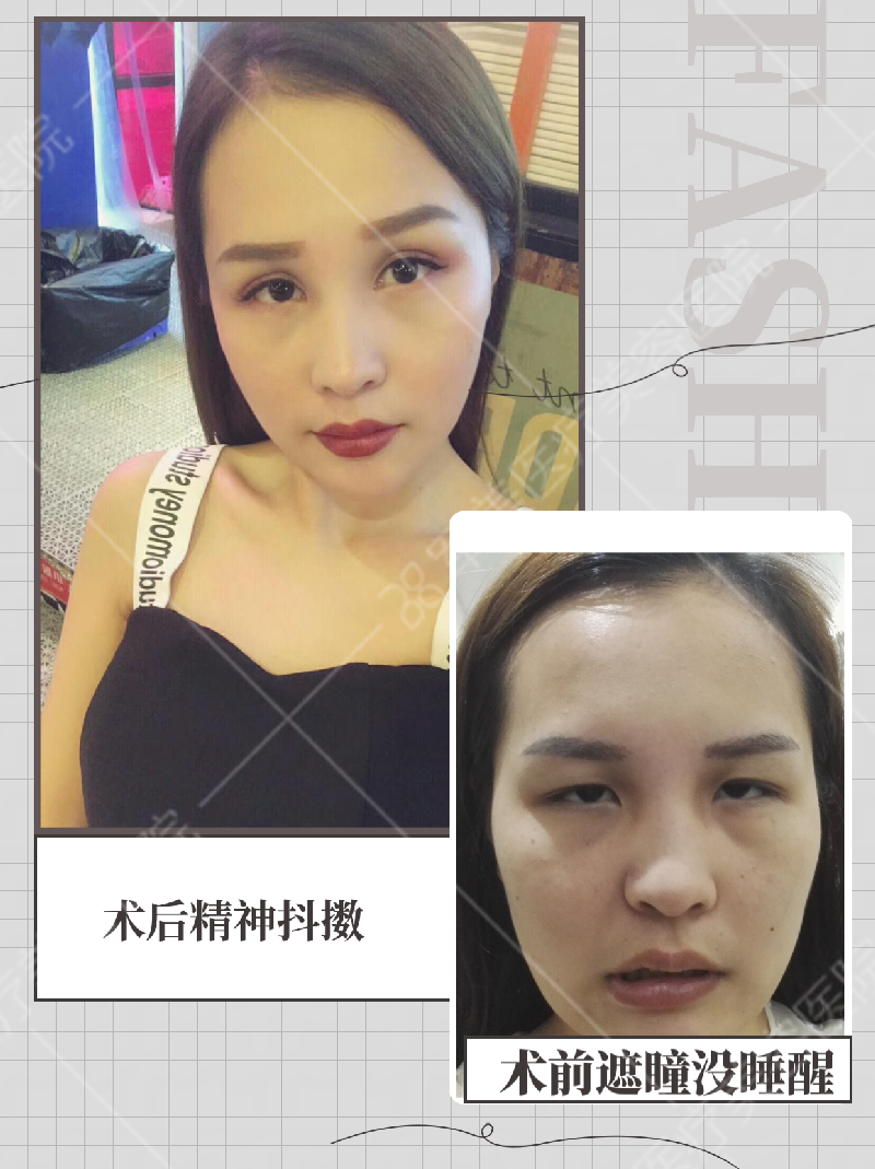 广州割双眼皮口碑好的医生